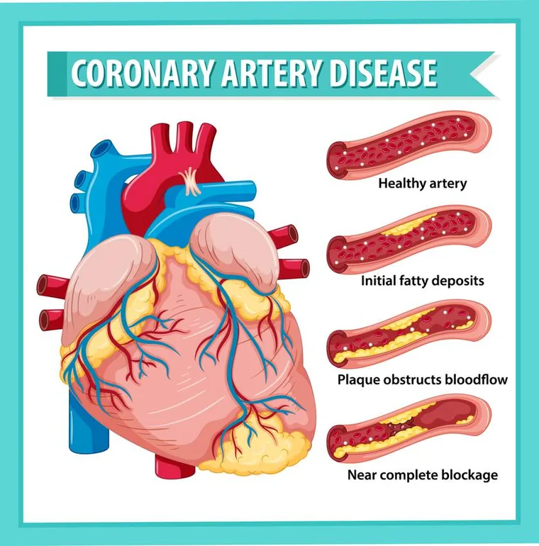 10 Myths about Cardiovascular Disease